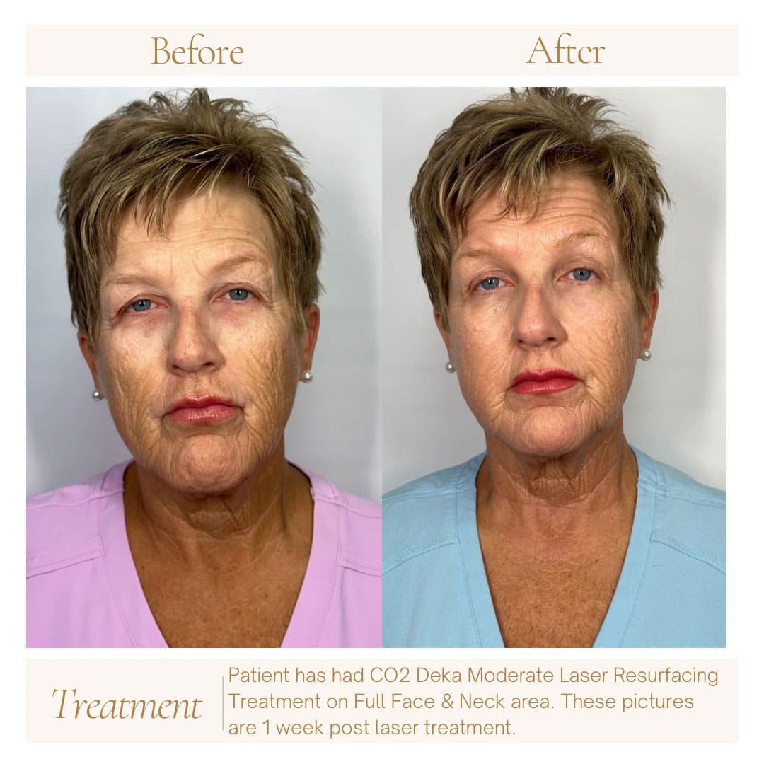 CO2-Deka-Moderate-Laser-Resurfacing-1-1