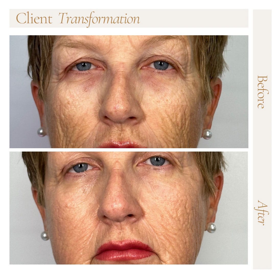 CO2-Deka-Moderate-Laser-Resurfacing-1-2