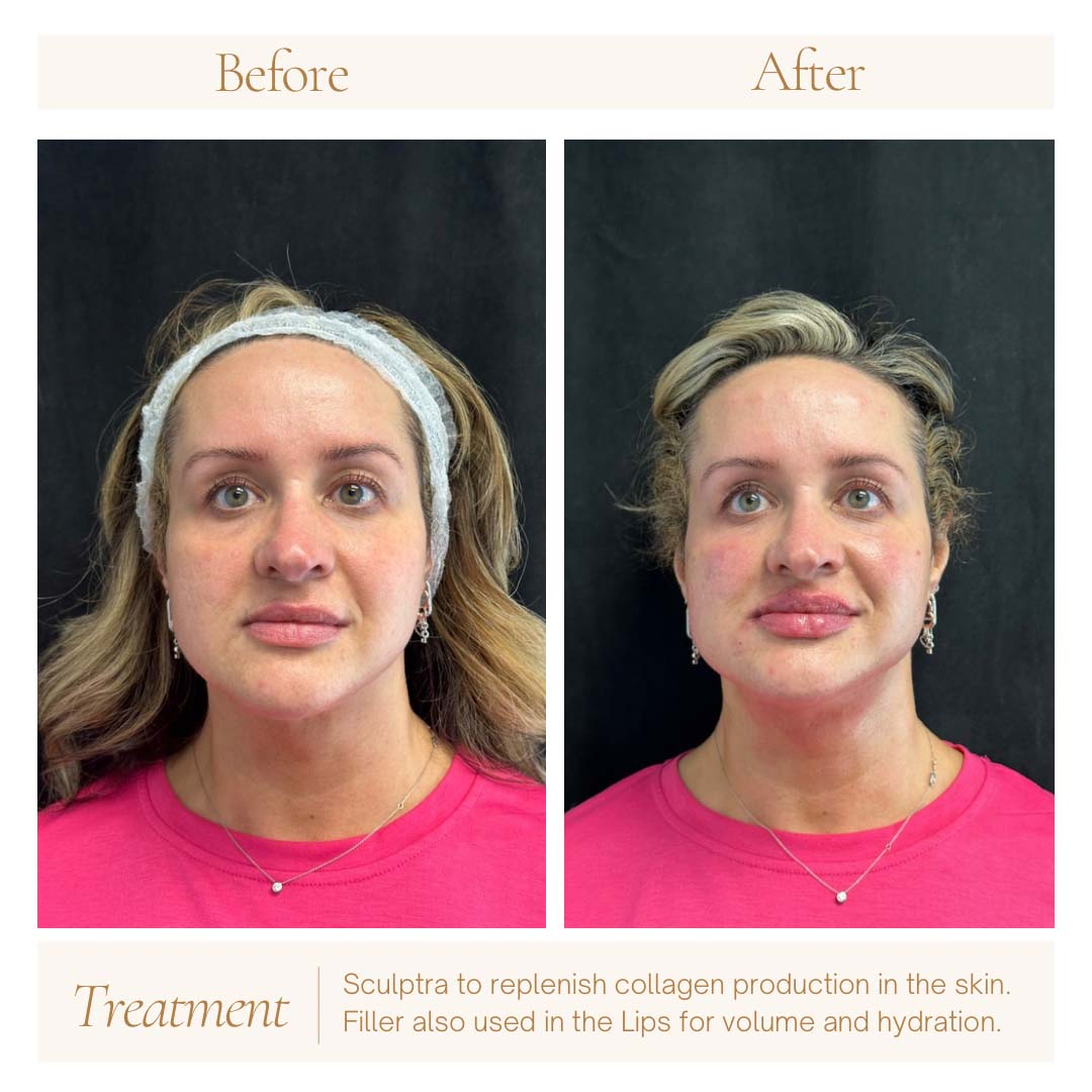 sculptra-filler-ba-1a
