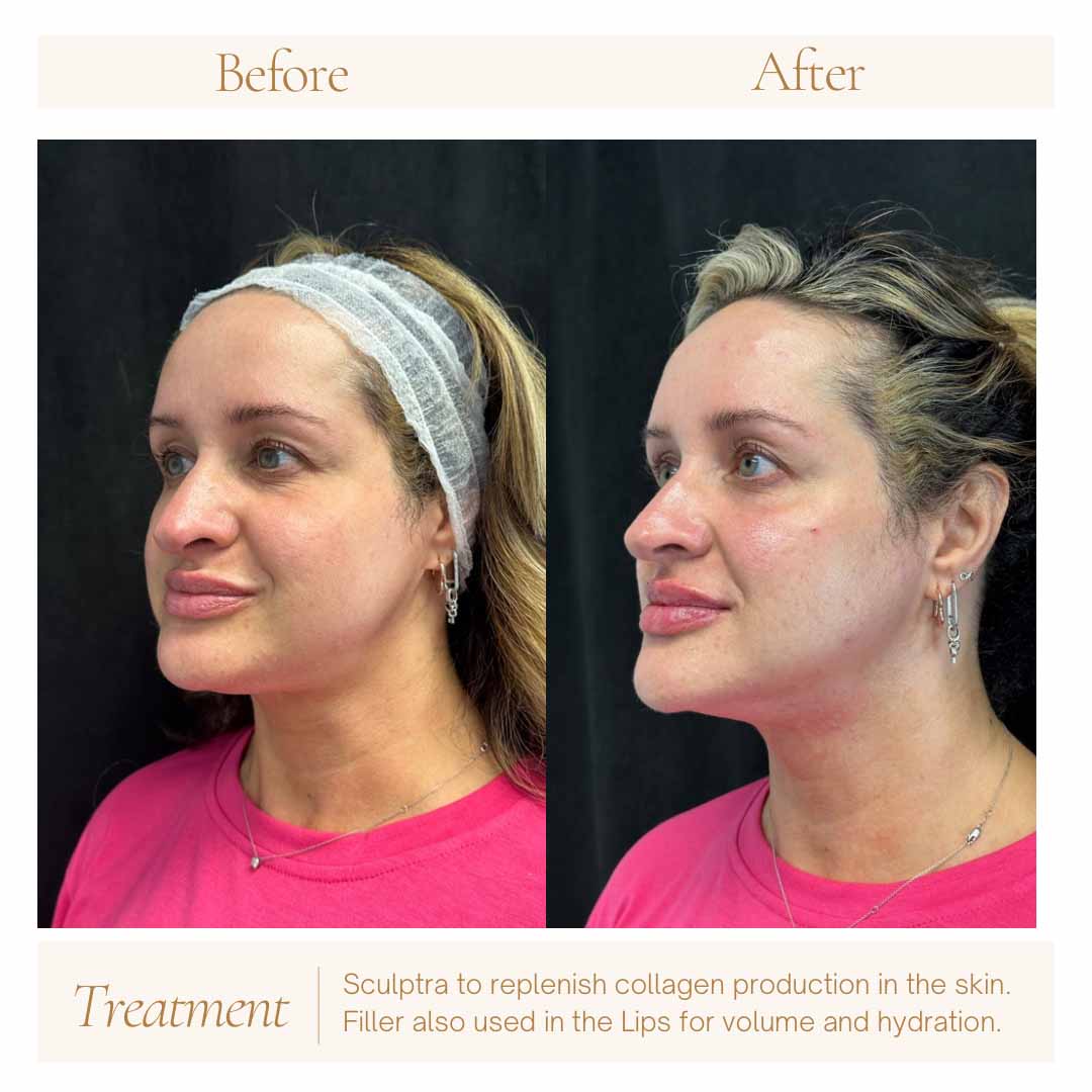 sculptra-filler-ba-1b