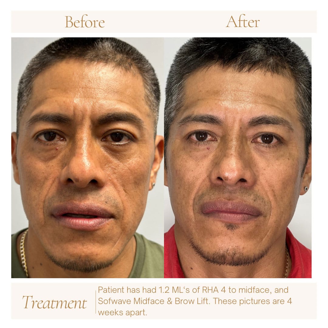 fillers-Sofwave-ba-1