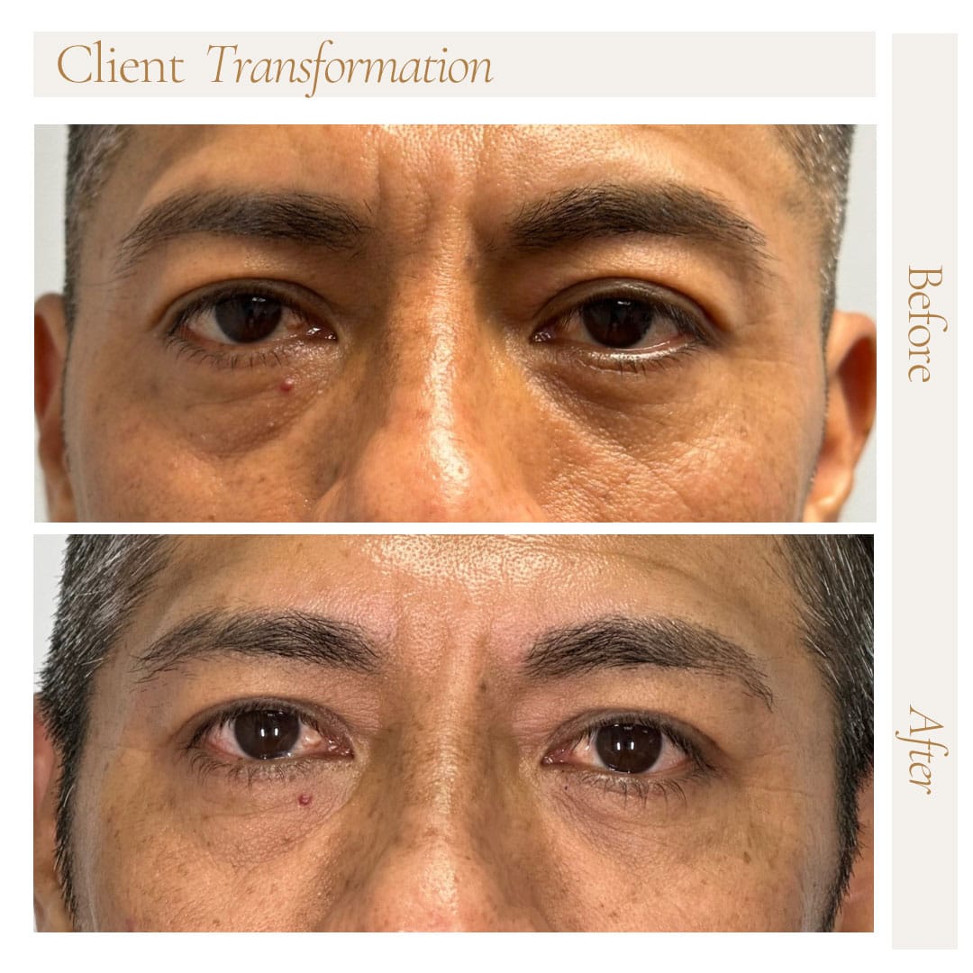fillers-Sofwave-ba-2