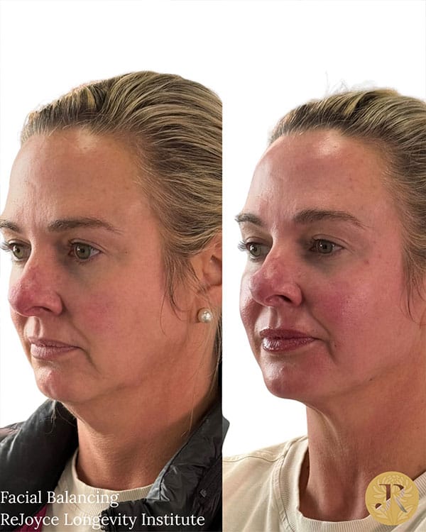 facial-balancing-1a facial-balancing-1a