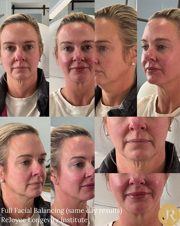 facial-balancing-1b facial-balancing-1b